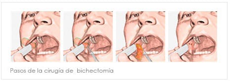 bichectomía hecha de mala forma